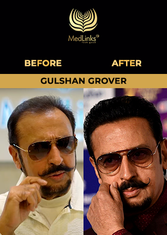 Virender Sehwag hair transplant before and after